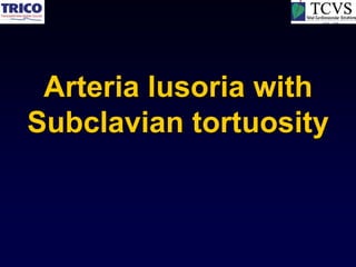 Arteria lusoria with
Subclavian tortuosity
 