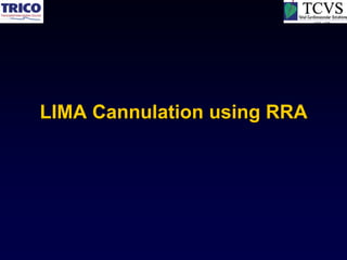LIMA Cannulation using RRA
 