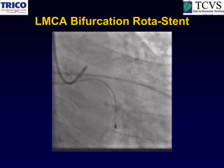 LMCA Bifurcation Rota-Stent
 
