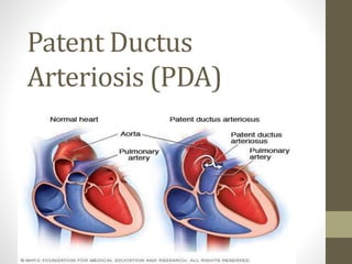 Patent Ductus
Arteriosis (PDA)
 