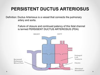 PERSISTENT DUCTUS ARTERIOSUS 
Definition: Ductus Arteriosus is a vessel that connects the pulmonary 
artery and aorta. 
Failure of closure and continued patency of this fetal channel 
is termed PERSISENT DUCTUS ARTERIOSUS (PDA) 
 