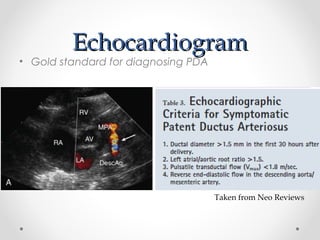 EEcchhooccaarrddiiooggrraamm 
• Gold standard for diagnosing PDA 
Taken from Neo Reviews 
 