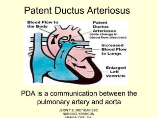 patent ductus arteriosus video