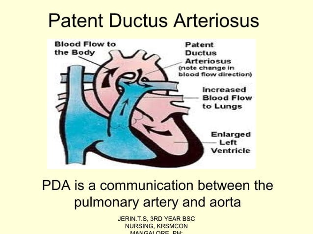 Patent ductus arteriosus | PPT