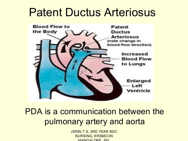 Patent Ductus Arteriosus