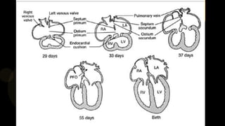 PATENT FORAMEN OVALE ASD OSTIUM
Right to left shunt Left to right shunt
normal or slightly elevated
pulmonary pressure,
pu...