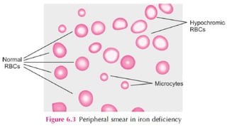 Overview of Anemia: Types, Pathogenesis, Clinical Features and Lab ...