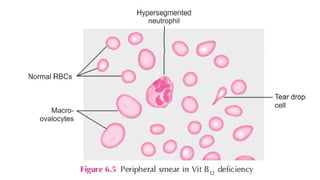 Overview of Anemia: Types, Pathogenesis, Clinical Features and Lab ...