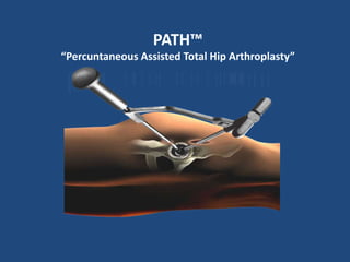 PATH™ “Percuntaneous Assisted Total Hip Arthroplasty” 