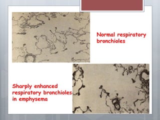 Normal respiratory 
bronchioles 
Sharply enhanced 
respiratory bronchioles 
in emphysema 
 