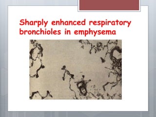 Sharply enhanced respiratory 
bronchioles in emphysema 
 