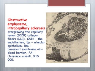 Obstructive 
emphysema, 
intracapillary sclerosis 
overgrowing the capillary 
lumen (SCCR) collagen 
fibers (LLR). CNN - the 
endothelium, Ep - alveolar 
epithelium, BM - 
basement membrane air-blood 
barrier, PA - 
clearance alveoli. X15 
000. 
 