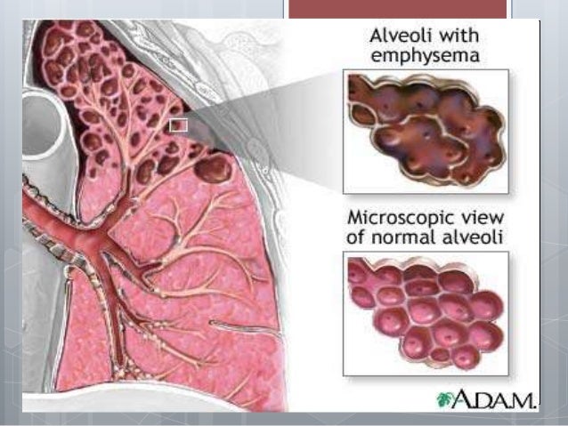 Pulmonary Emphysema. Pathomorphology, outcomes, complications