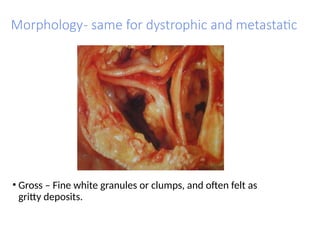 Morphology- same for dystrophic and metastatic
• Gross – Fine white granules or clumps, and often felt as
gritty deposits.
 