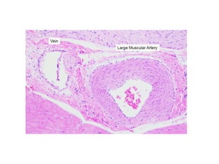 Path calcification for mbbs 2nd year pathology