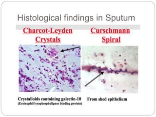 Histological findings in Sputum
 