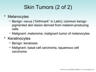 Skin Tumors (2 of 2)
• Melanocytes
– Benign: nevus (“birthmark” in Latin); common benign
pigmented skin lesion derived from melanin-producing
cells
– Malignant: melanoma; malignant tumor of melanocytes
• Keratinocytes
– Benign: keratoses
– Malignant: basal cell carcinoma, squamous cell
carcinoma
 