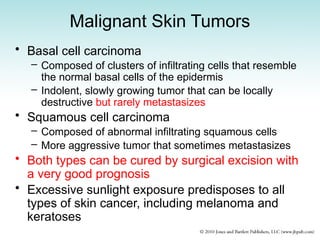 Malignant Skin Tumors
• Basal cell carcinoma
– Composed of clusters of infiltrating cells that resemble
the normal basal cells of the epidermis
– Indolent, slowly growing tumor that can be locally
destructive but rarely metastasizes
• Squamous cell carcinoma
– Composed of abnormal infiltrating squamous cells
– More aggressive tumor that sometimes metastasizes
• Both types can be cured by surgical excision with
a very good prognosis
• Excessive sunlight exposure predisposes to all
types of skin cancer, including melanoma and
keratoses
 