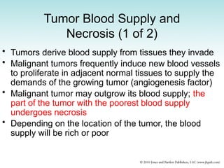 Tumor Blood Supply and
Necrosis (1 of 2)
• Tumors derive blood supply from tissues they invade
• Malignant tumors frequently induce new blood vessels
to proliferate in adjacent normal tissues to supply the
demands of the growing tumor (angiogenesis factor)
• Malignant tumor may outgrow its blood supply; the
part of the tumor with the poorest blood supply
undergoes necrosis
• Depending on the location of the tumor, the blood
supply will be rich or poor
 