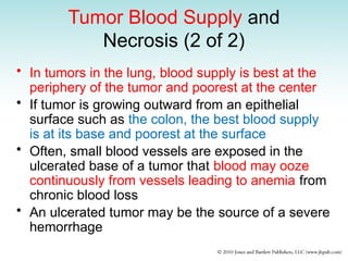 Tumor Blood Supply and
Necrosis (2 of 2)
• In tumors in the lung, blood supply is best at the
periphery of the tumor and poorest at the center
• If tumor is growing outward from an epithelial
surface such as the colon, the best blood supply
is at its base and poorest at the surface
• Often, small blood vessels are exposed in the
ulcerated base of a tumor that blood may ooze
continuously from vessels leading to anemia from
chronic blood loss
• An ulcerated tumor may be the source of a severe
hemorrhage
 