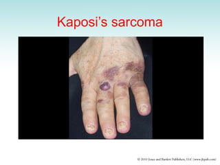 Kaposi’s sarcoma
 