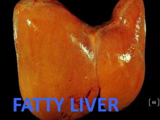 FATTY LIVER 66
 