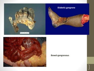 84
Bowel-gangrenous
Diabetic gangrene
 