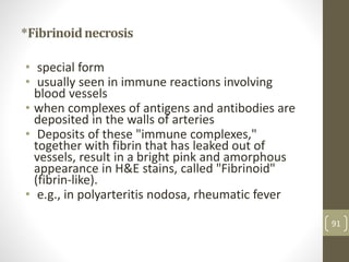 *Fibrinoidnecrosis
• special form
• usually seen in immune reactions involving
blood vessels
• when complexes of antigens and antibodies are
deposited in the walls of arteries
• Deposits of these "immune complexes,"
together with fibrin that has leaked out of
vessels, result in a bright pink and amorphous
appearance in H&E stains, called "Fibrinoid"
(fibrin-like).
• e.g., in polyarteritis nodosa, rheumatic fever
91
 