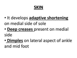 SKIN
• It develops adaptive shortening
on medial side of sole
• Deep creases present on medial
side
• Dimples on lateral aspect of ankle
and mid foot
 