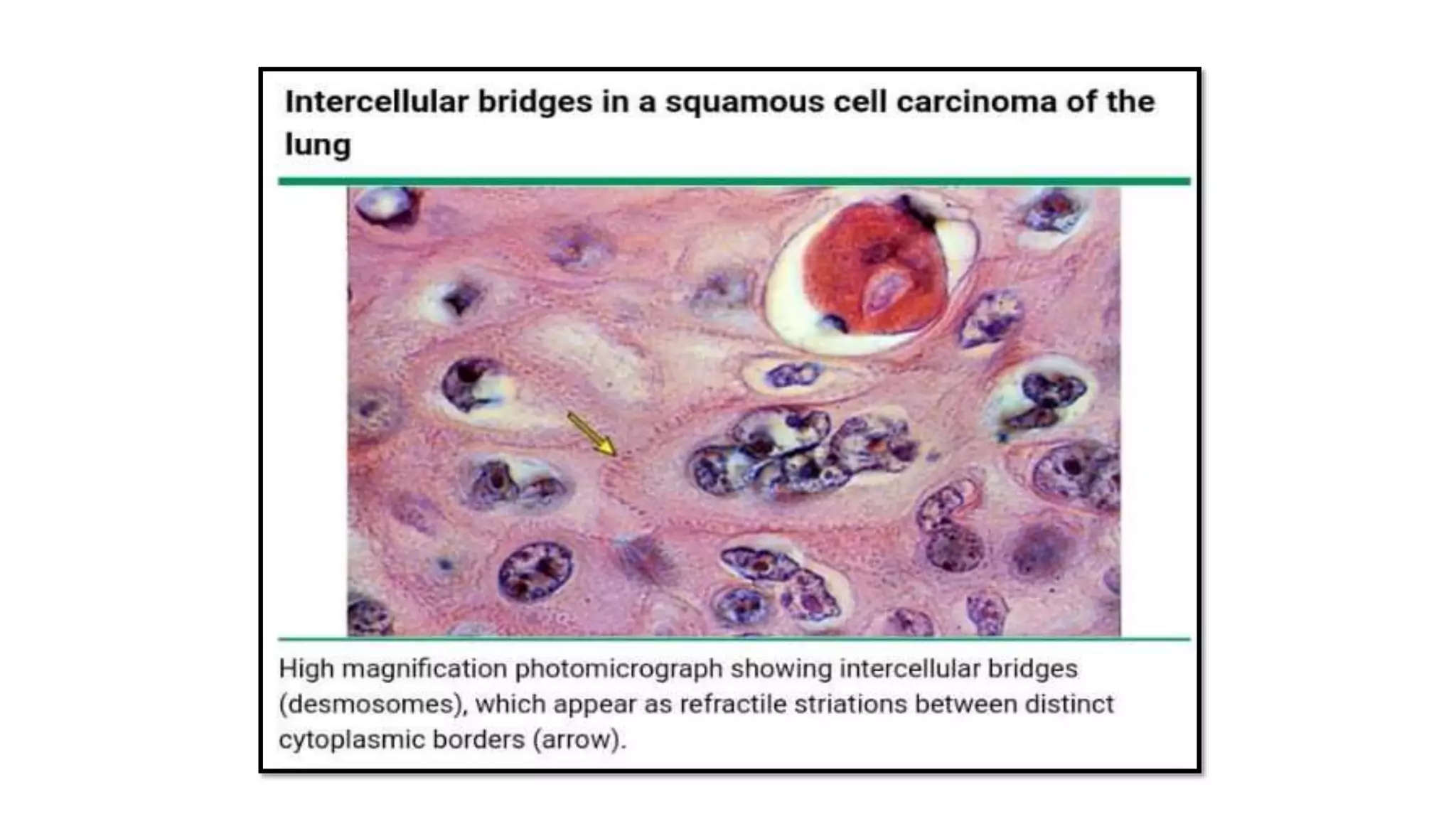 Intercellular Bridges Pathology
