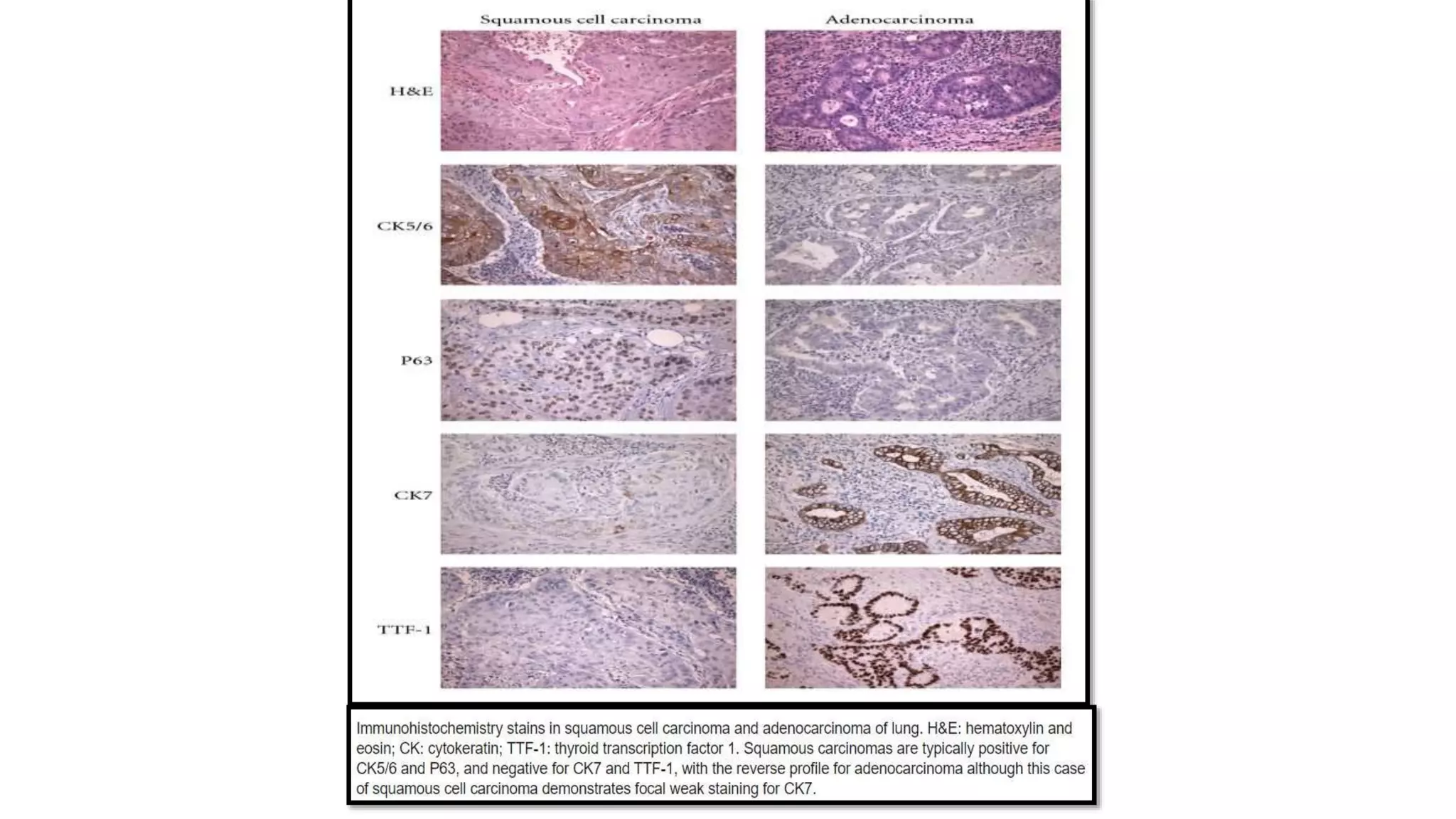 Pathology case presentation with discussion, squamous cell carcinoma ...