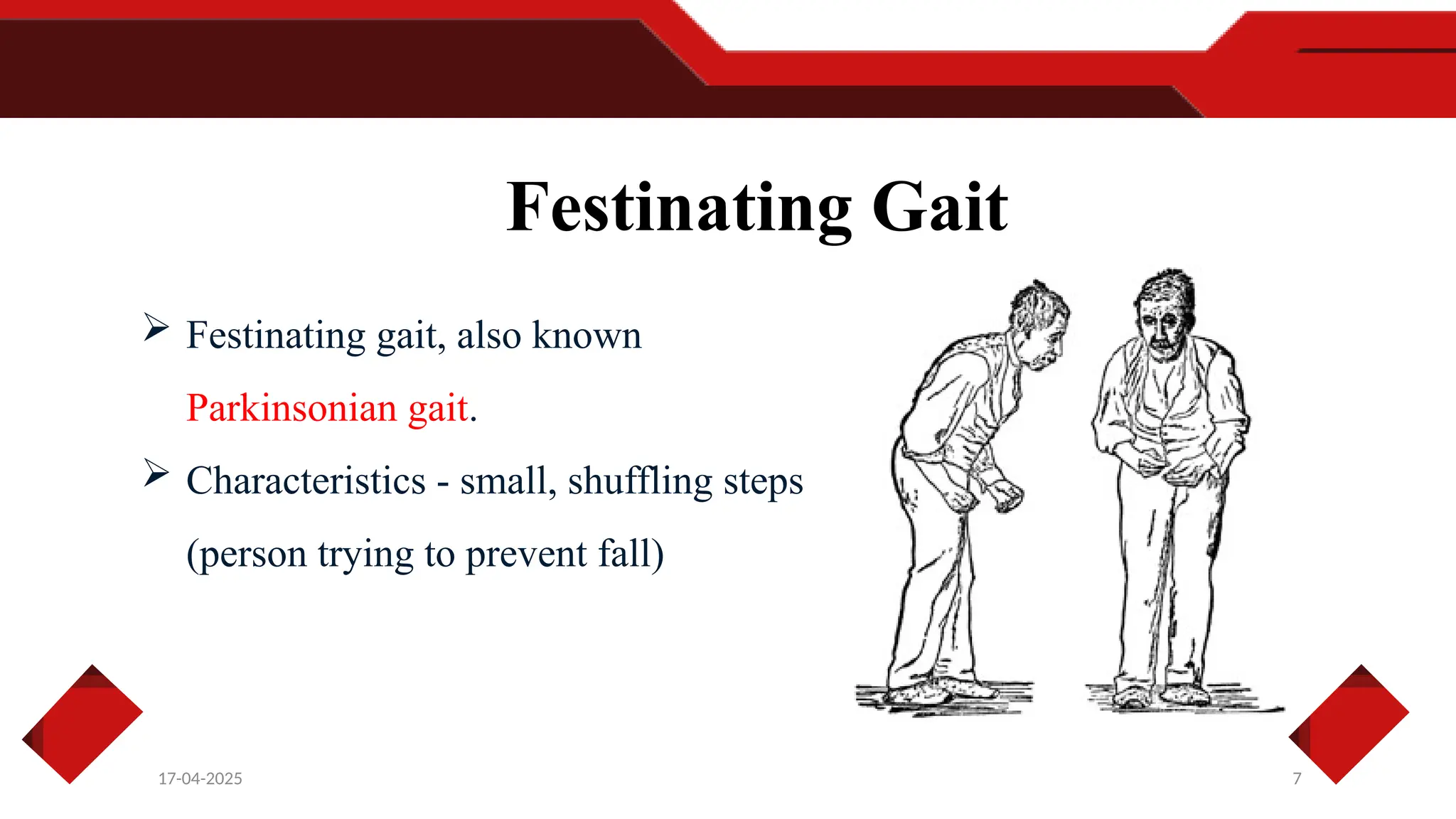 7
17-04-2025
Festinating Gait
 Festinating gait, also known
Parkinsonian gait.
 Characteristics - small, shuffling steps
(person trying to prevent fall)
 