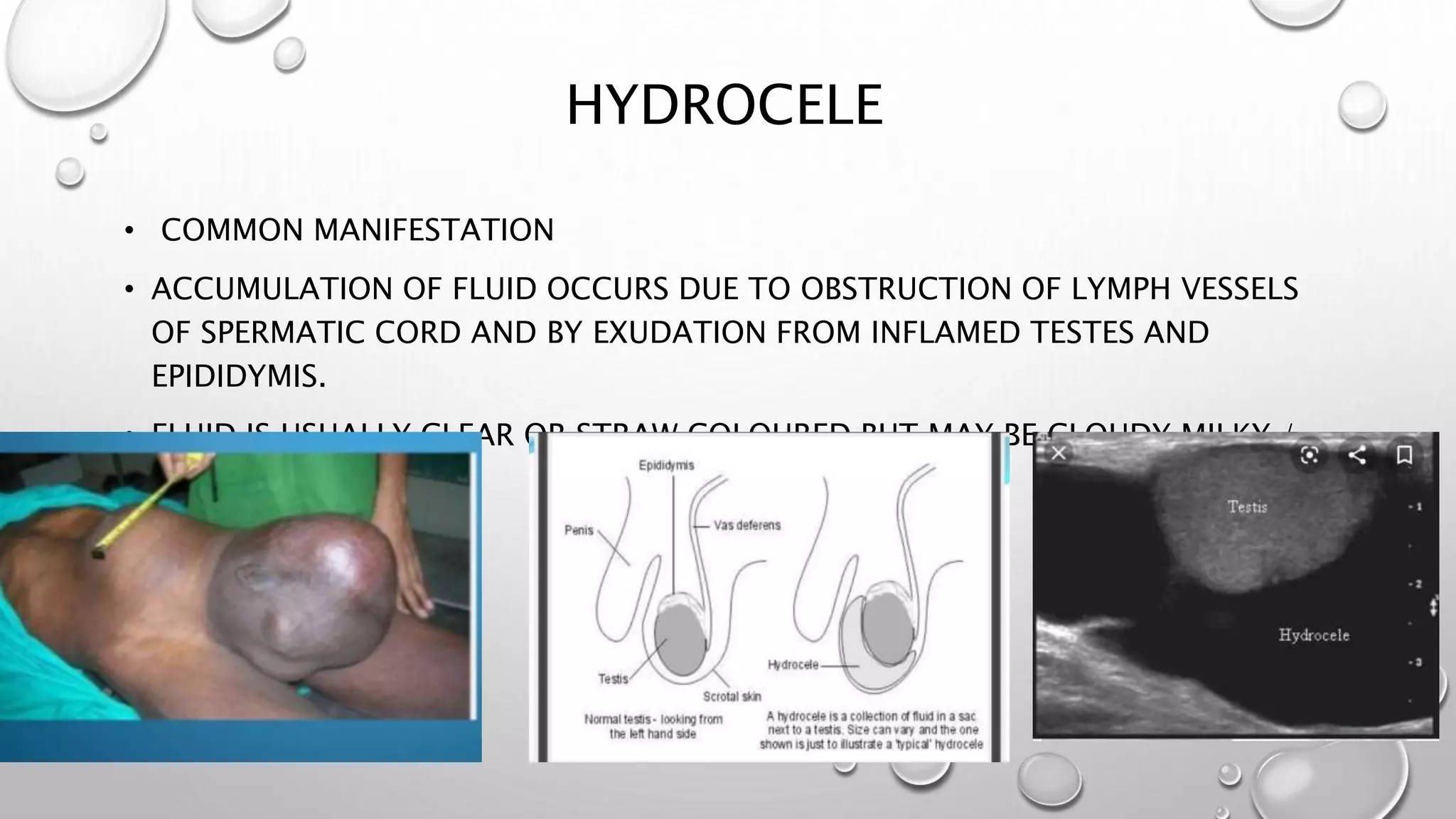 HYDROCELE
• COMMON MANIFESTATION
• ACCUMULATION OF FLUID OCCURS DUE TO OBSTRUCTION OF LYMPH VESSELS
OF SPERMATIC CORD AND BY EXUDATION FROM INFLAMED TESTES AND
EPIDIDYMIS.
• FLUID IS USUALLY CLEAR OR STRAW COLOURED BUT MAY BE CLOUDY,MILKY /
HEMORRHAGIC.