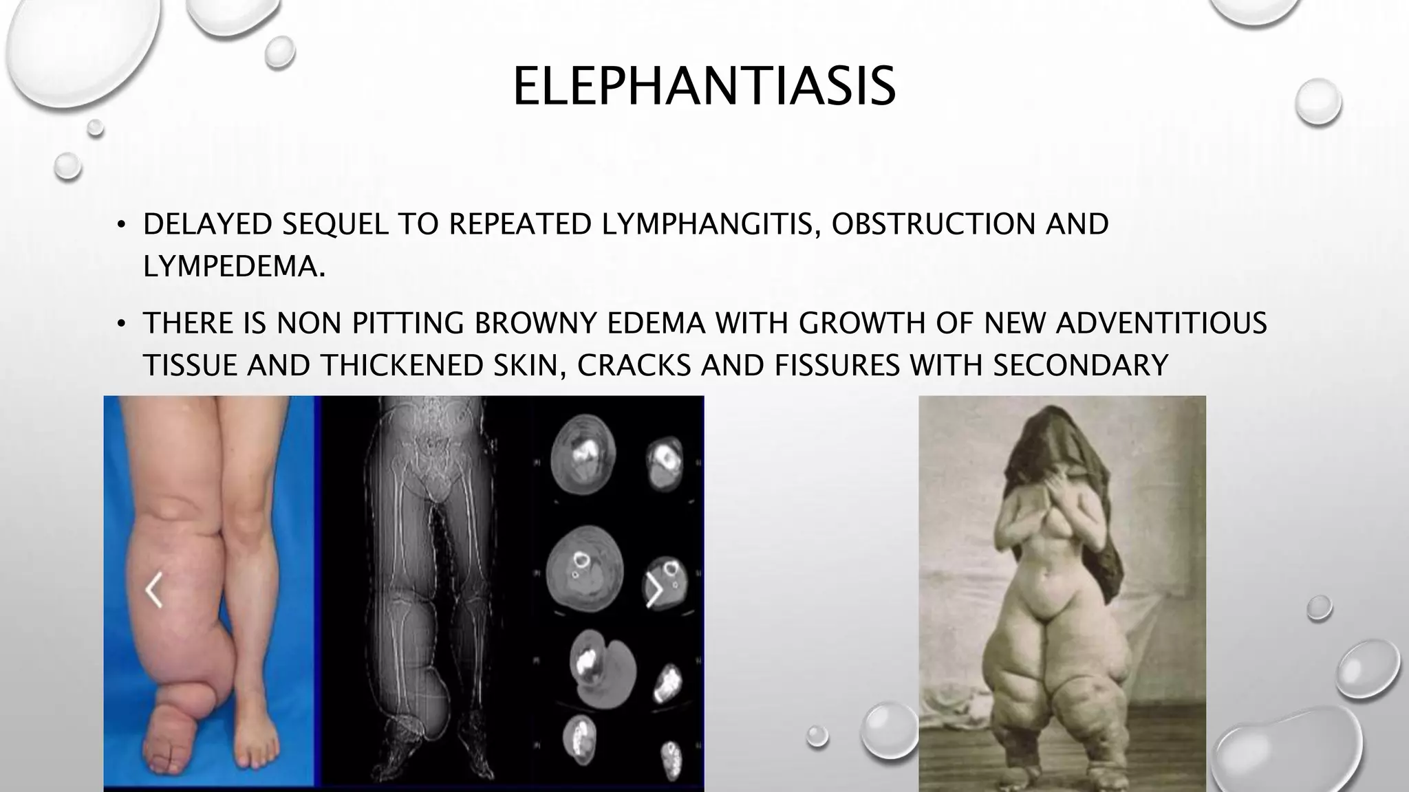 ELEPHANTIASIS
• DELAYED SEQUEL TO REPEATED LYMPHANGITIS, OBSTRUCTION AND
LYMPEDEMA.
• THERE IS NON PITTING BROWNY EDEMA WITH GROWTH OF NEW ADVENTITIOUS
TISSUE AND THICKENED SKIN, CRACKS AND FISSURES WITH SECONDARY
BACTERIAL OR FUNGAL INFECTION.