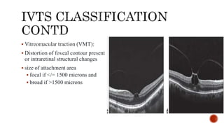 Pathogenesis and management of macular holes with video demonstration.pptx