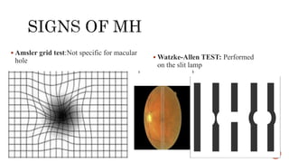 Pathogenesis and management of macular holes with video demonstration.pptx