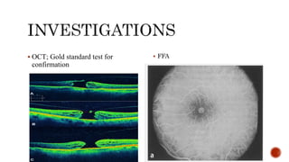 Pathogenesis and management of macular holes with video demonstration.pptx