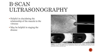 Pathogenesis and management of macular holes with video demonstration.pptx