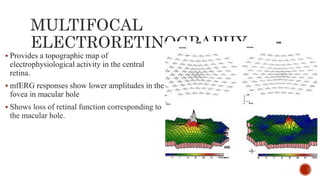 Pathogenesis and management of macular holes with video demonstration.pptx