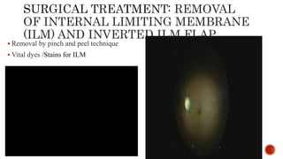 Pathogenesis and management of macular holes with video demonstration.pptx
