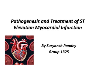 Pathogenesis and Treatment of ST
Elevation Myocardial Infarction
By Suryansh Pandey
Group 1325
 