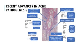 PATHOGENESIS OF ACNE VULGARIS- HORMONALS | PPTX