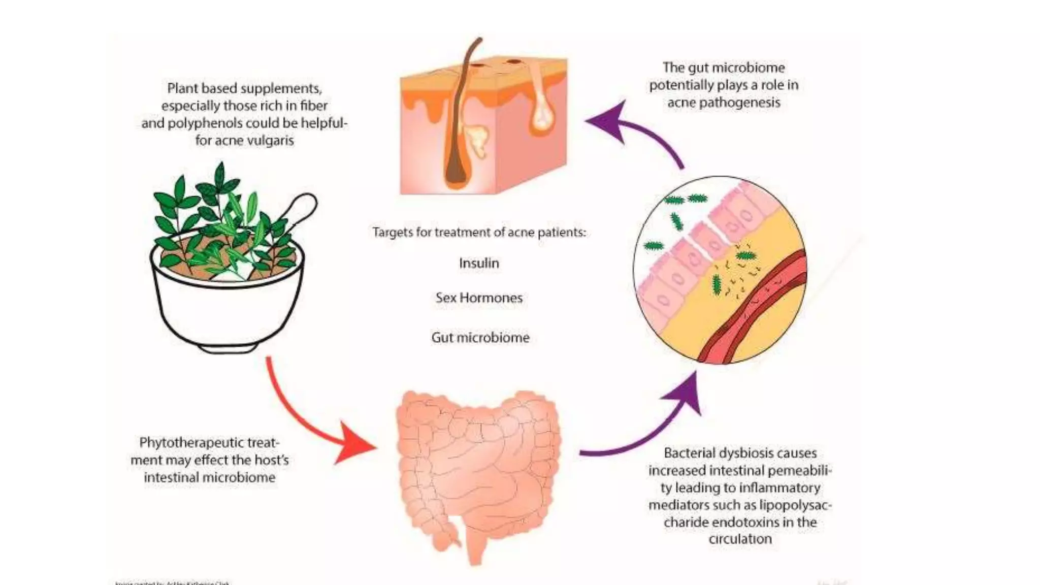 Pathogenesis of acne | PPTX