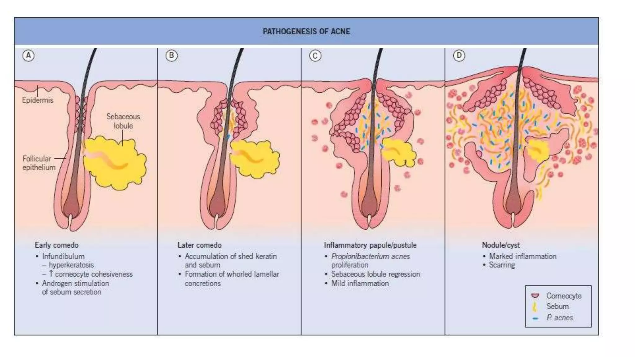 Pathogenesis of acne | PPTX