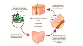 Pathogenesis of acne | PPTX