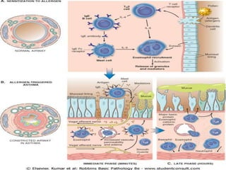 Pathogenesis of asthma | PPTX