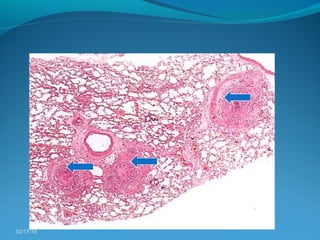 Pathogenesis of bronchial asthma | PPT