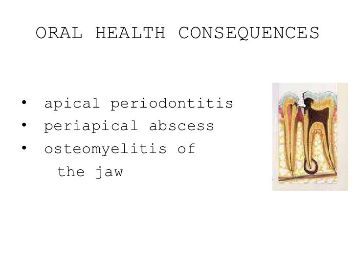 Pathogenesis of dental caries