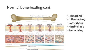 Normal bone healing cont
• Hematoma
• Inflammatory
• Soft callous
• Hard callous
• Remodeling
 