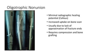 Oligotrophic Nonunion
• Minimal radiographic healing
potential (Callous)
• Increased uptake on bone scan
• Usually due to lack of
approximation of fracture ends
• Requires compression and bone
grafting
 